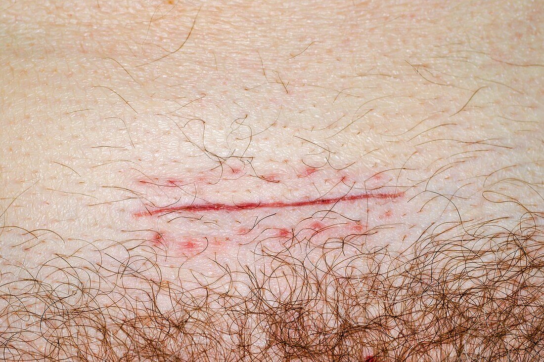 Caesarean section scar