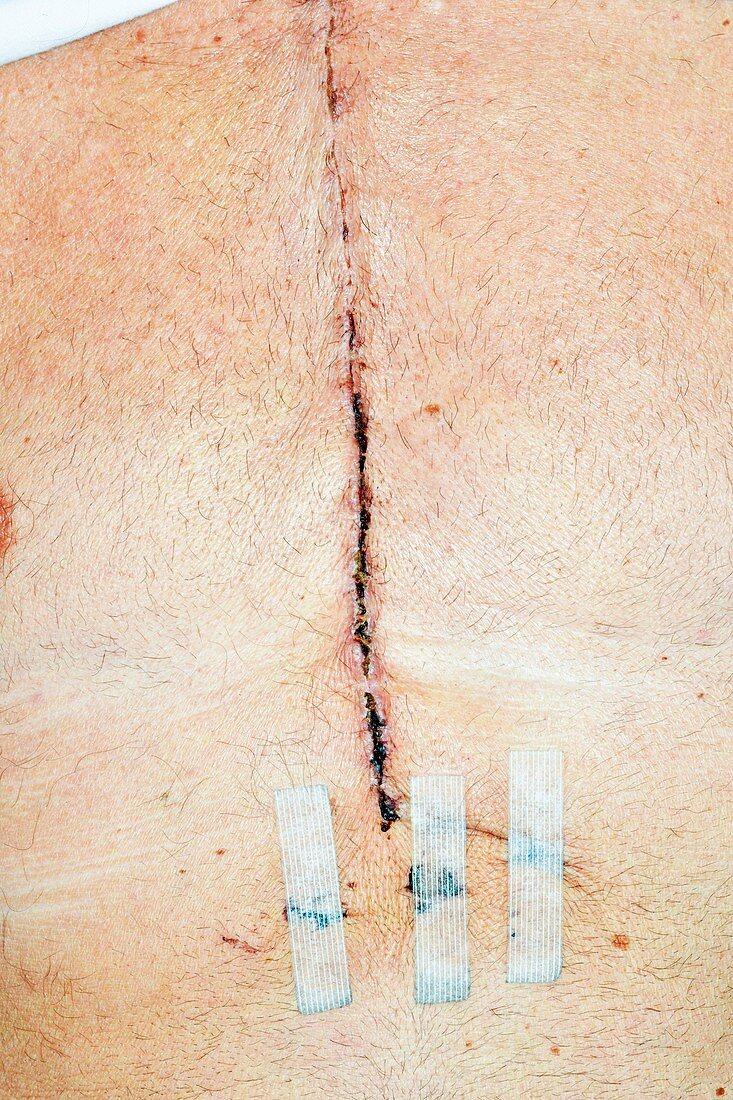 Heart bypass surgery scar