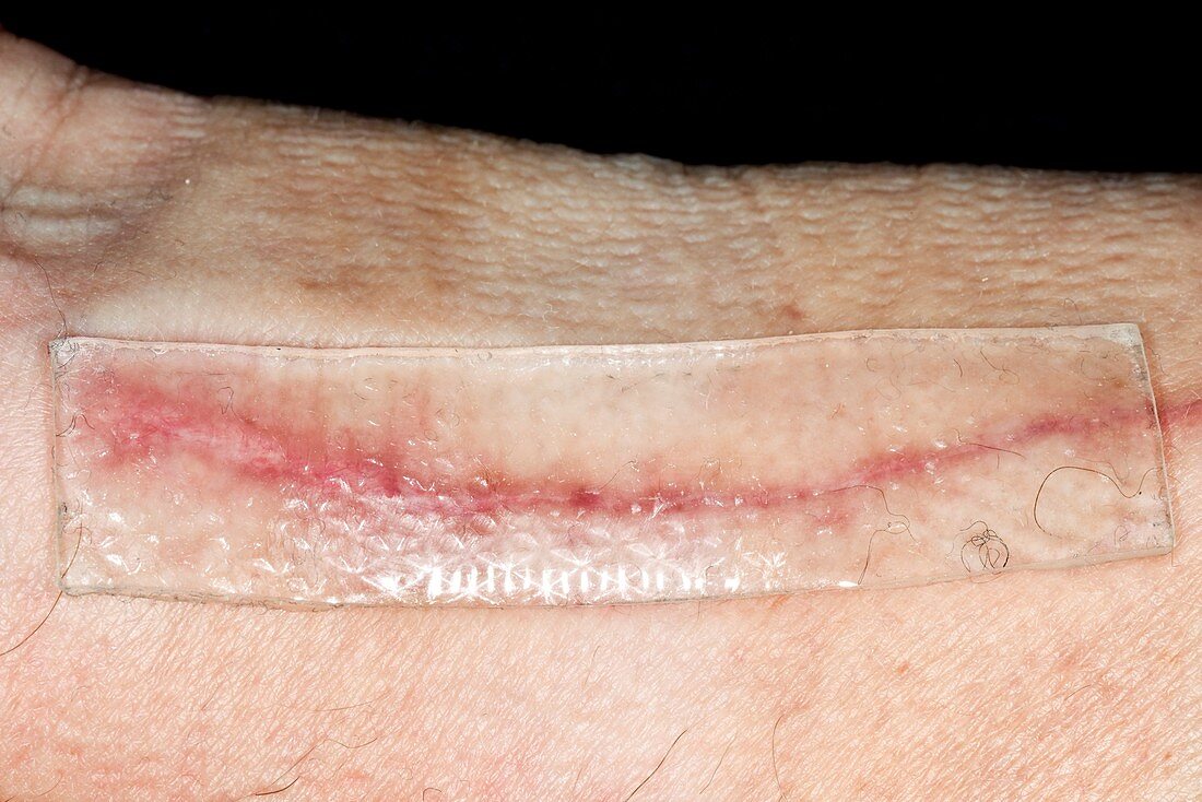 Keloid scar treatment