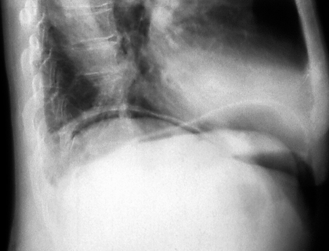 Abdominal air pockets,X-ray