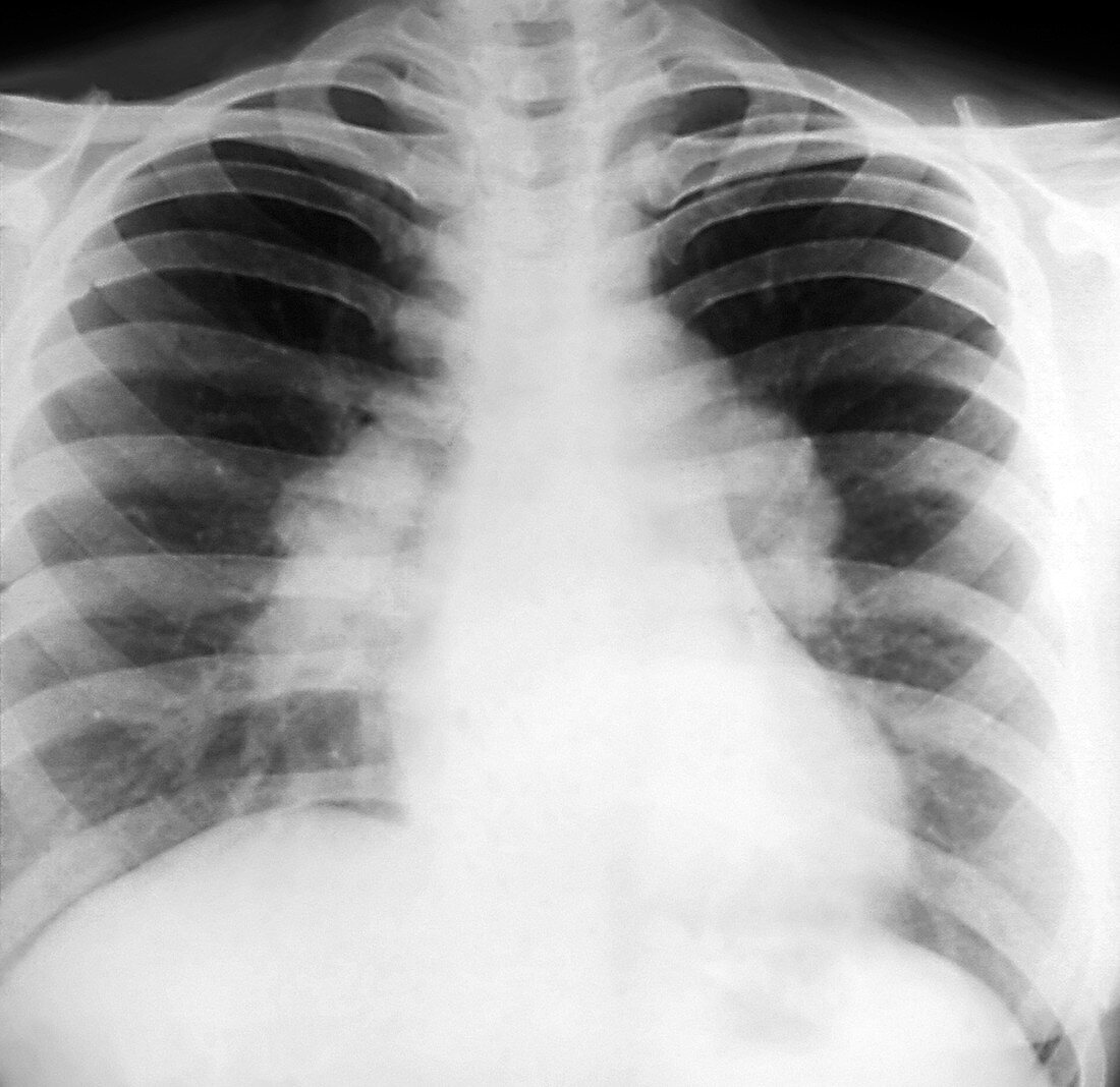 Pulmonary sarcoidosis,X-ray