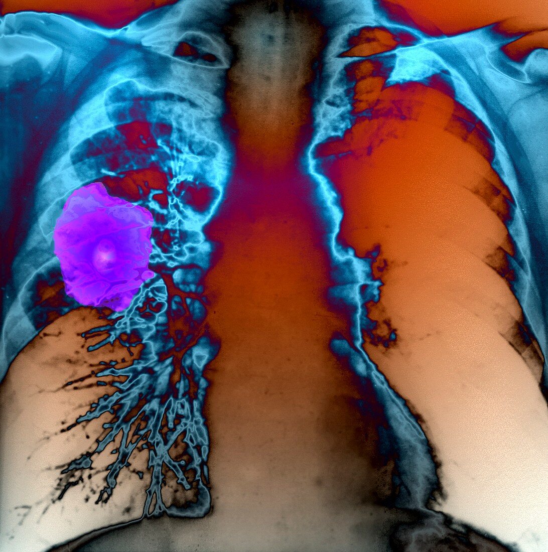 Lung tumour,X-ray