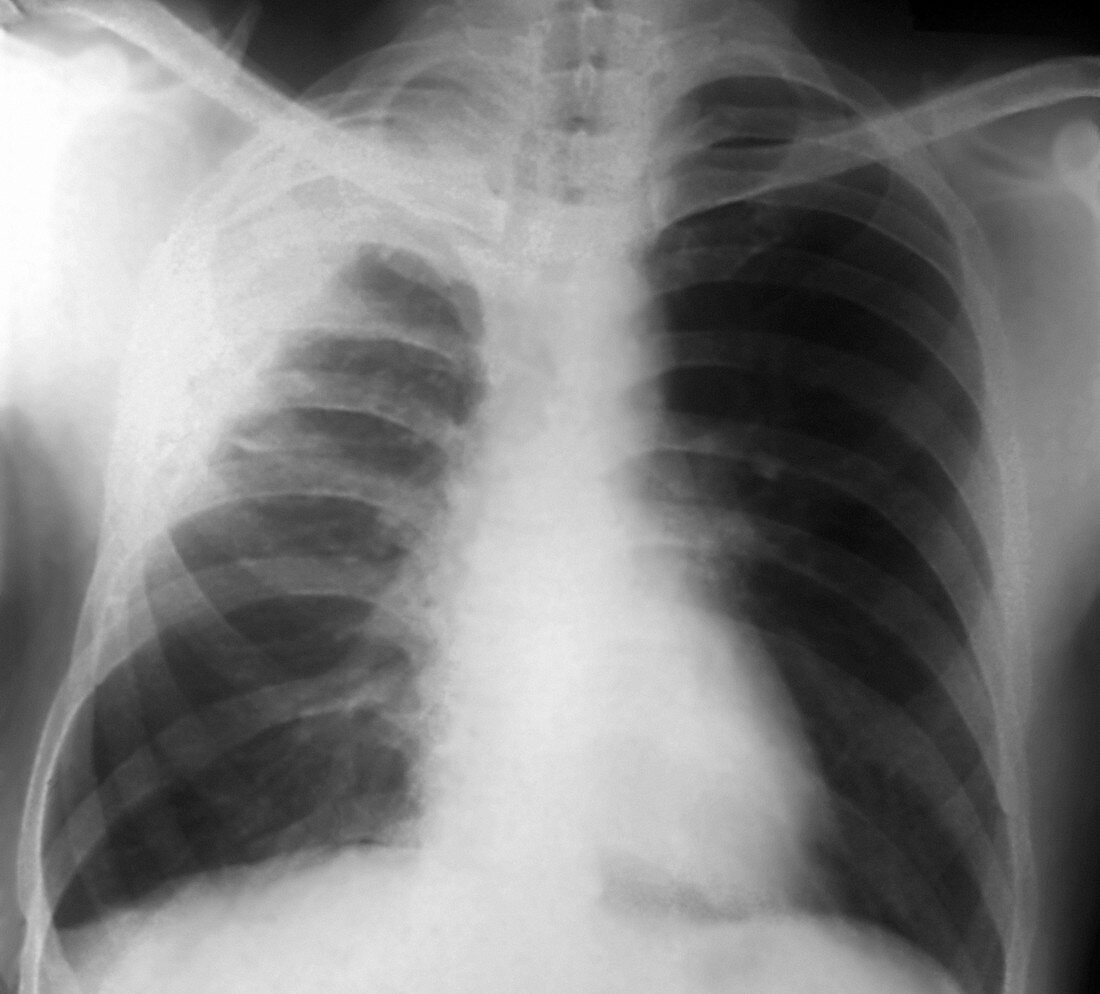 Pleurisy,X-ray