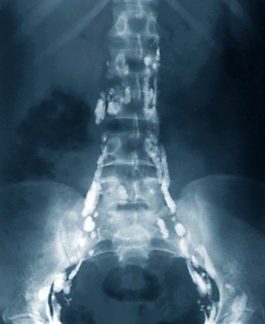 Normal lymphatic system,X-ray