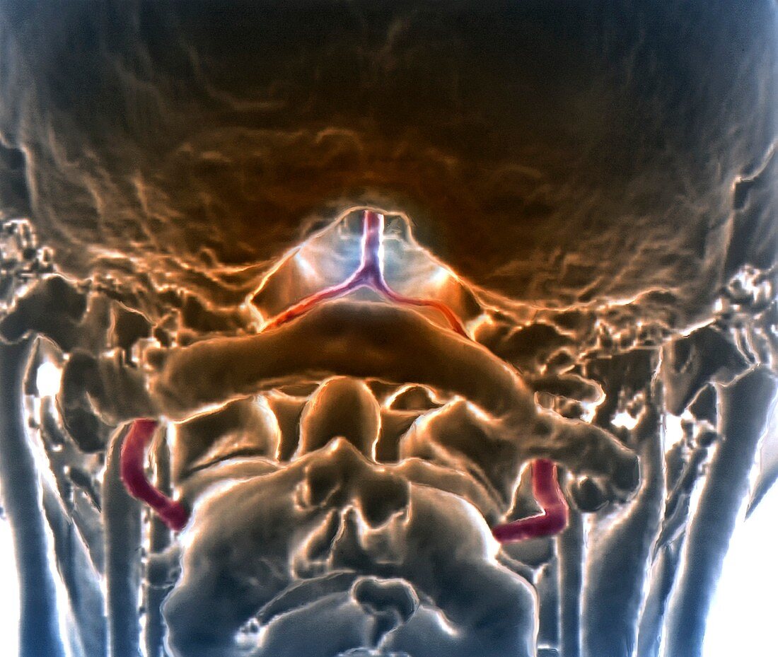 Decreased brain blood flow,3D CT scan