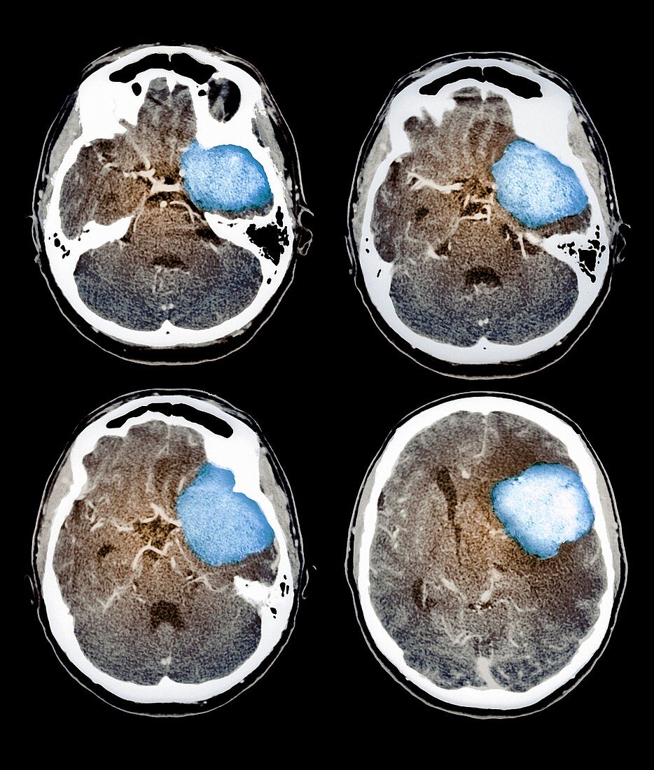 Brain tumour,CT scans
