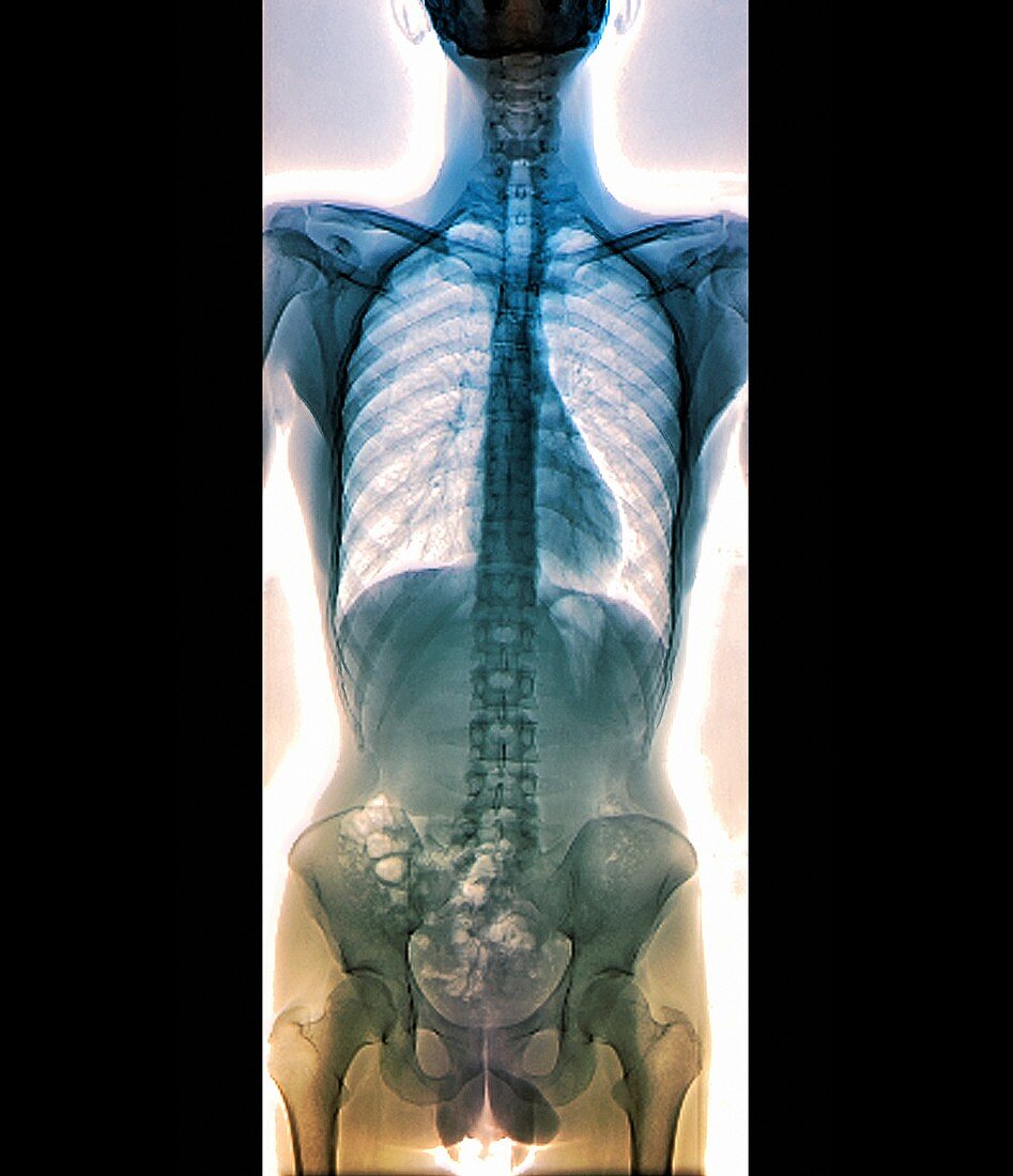 Normal spine,X-ray