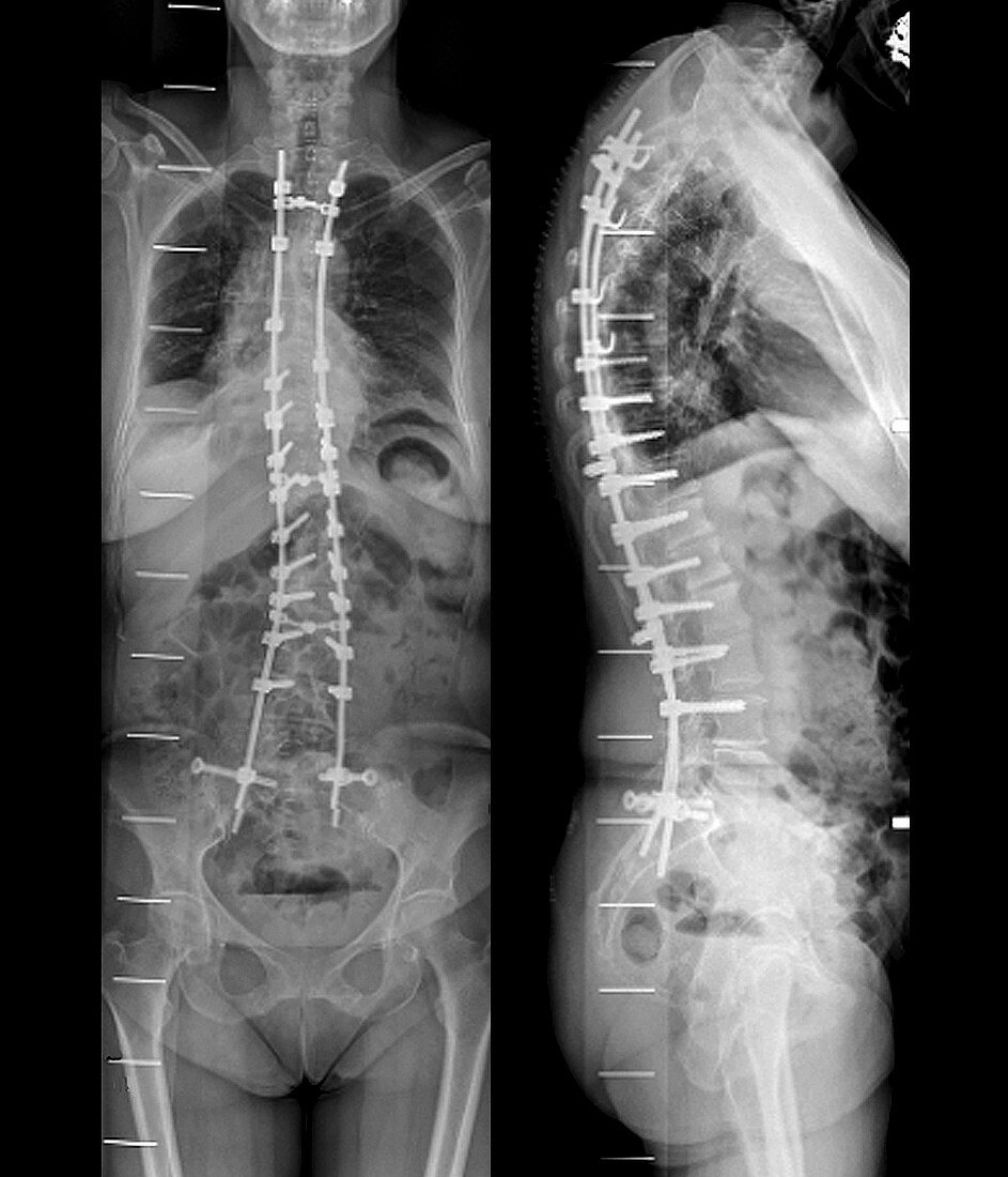 Curvature of the spine after surgery