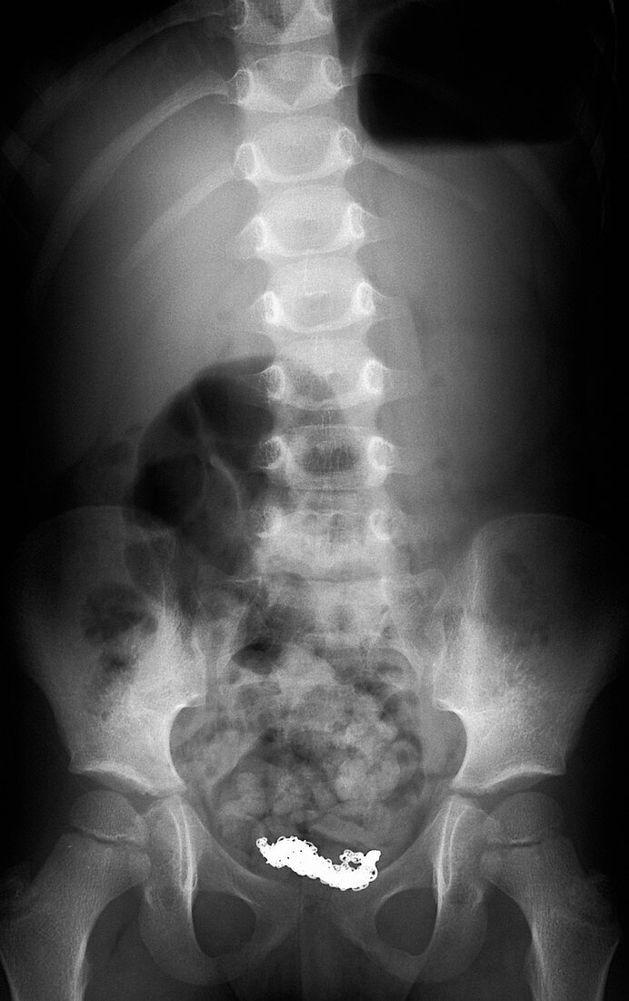 Swallowed necklace,X-ray