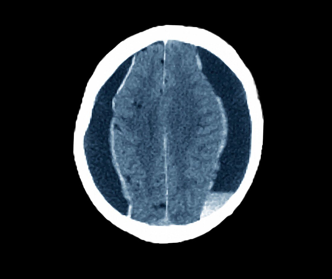 Brain haemorrhage in alcoholism,MRI