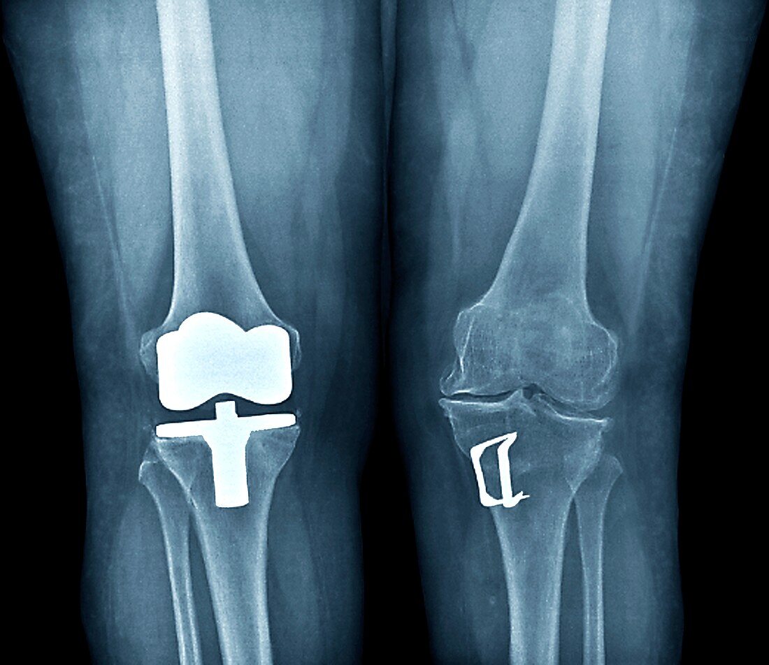 Knees after corrective surgery,X-ray