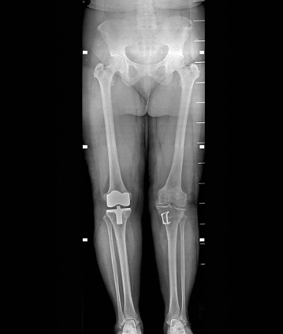 Knees after corrective surgery,X-ray
