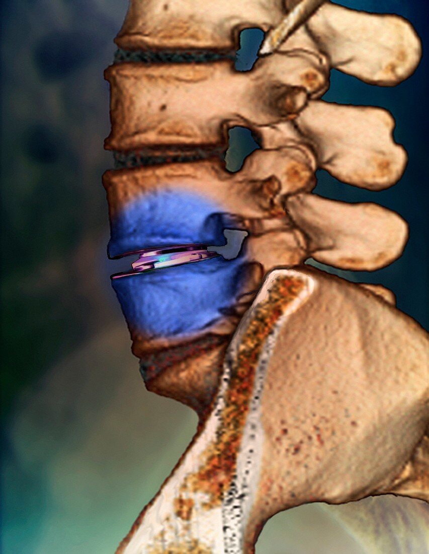 Spinal disc implant,3D CT scan
