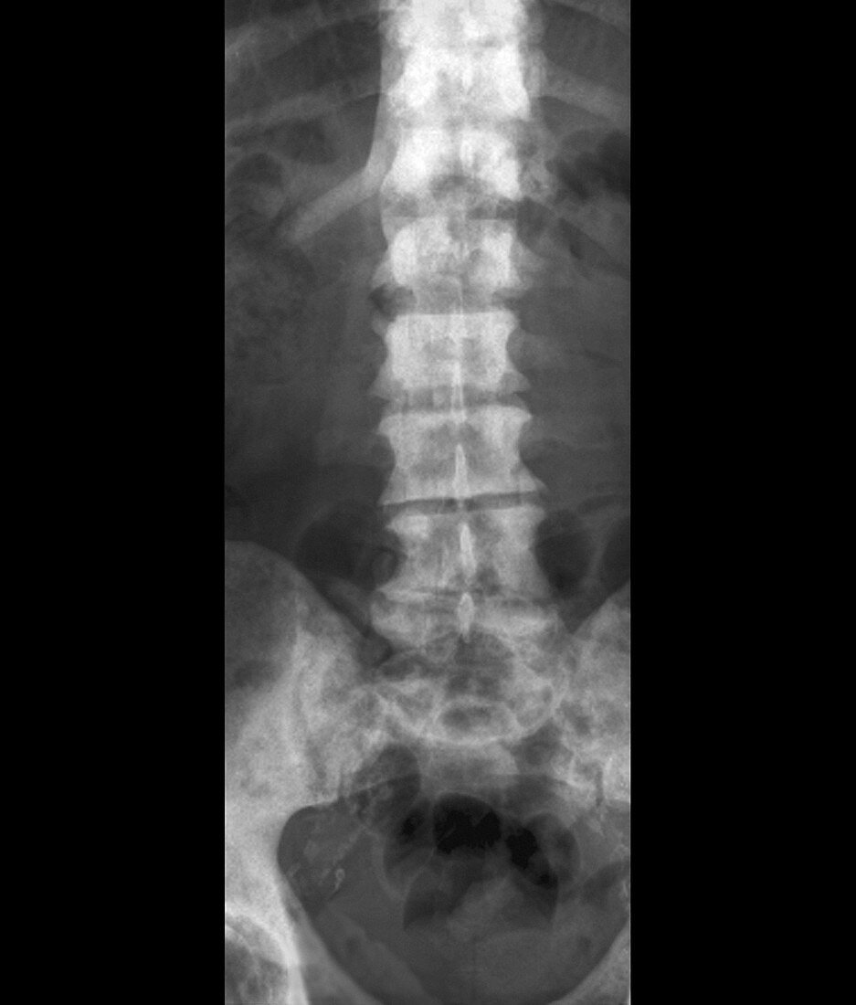 Secondary spinal cancer,X-ray