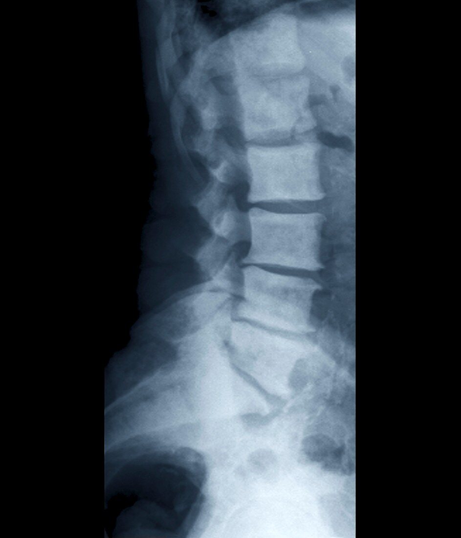 Secondary spinal cancer,X-ray