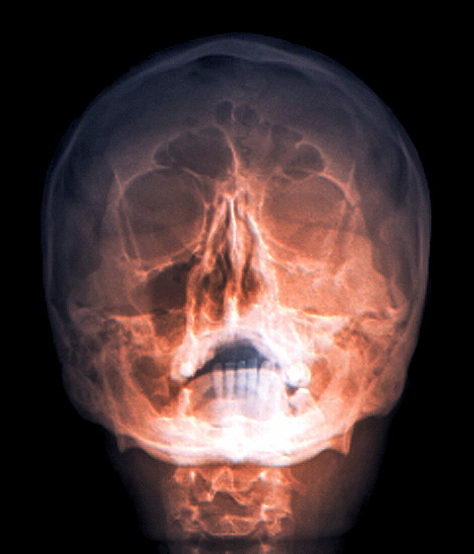 Fractured skull,X-ray