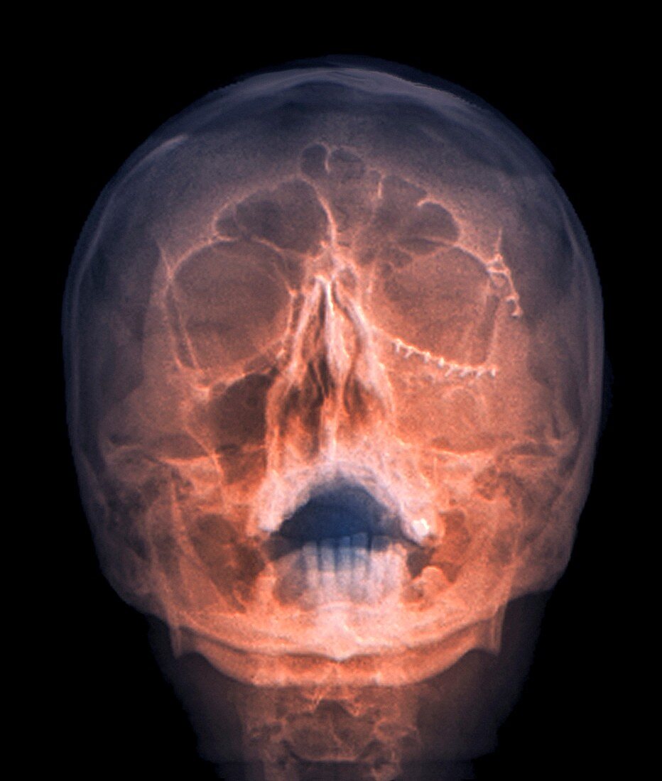 Fixed skull fractures,X-ray