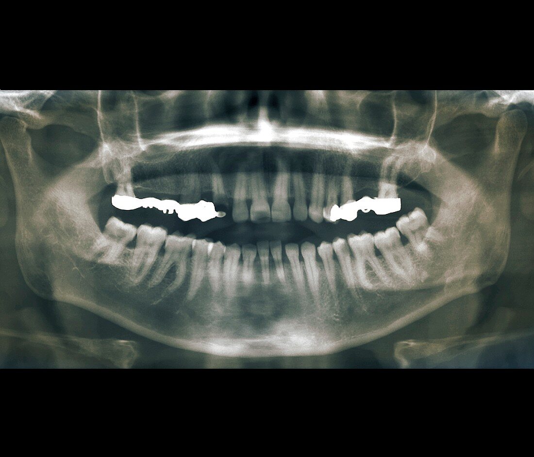 Dental bridge,X-ray
