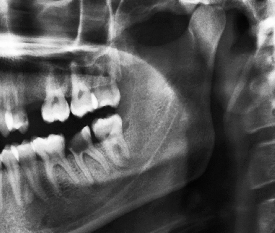 Tooth decay,X-ray