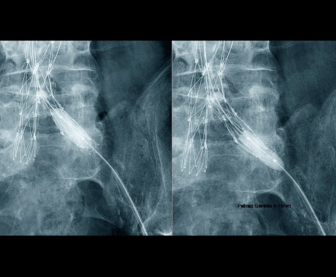 Balloon angioplasty,X-ray