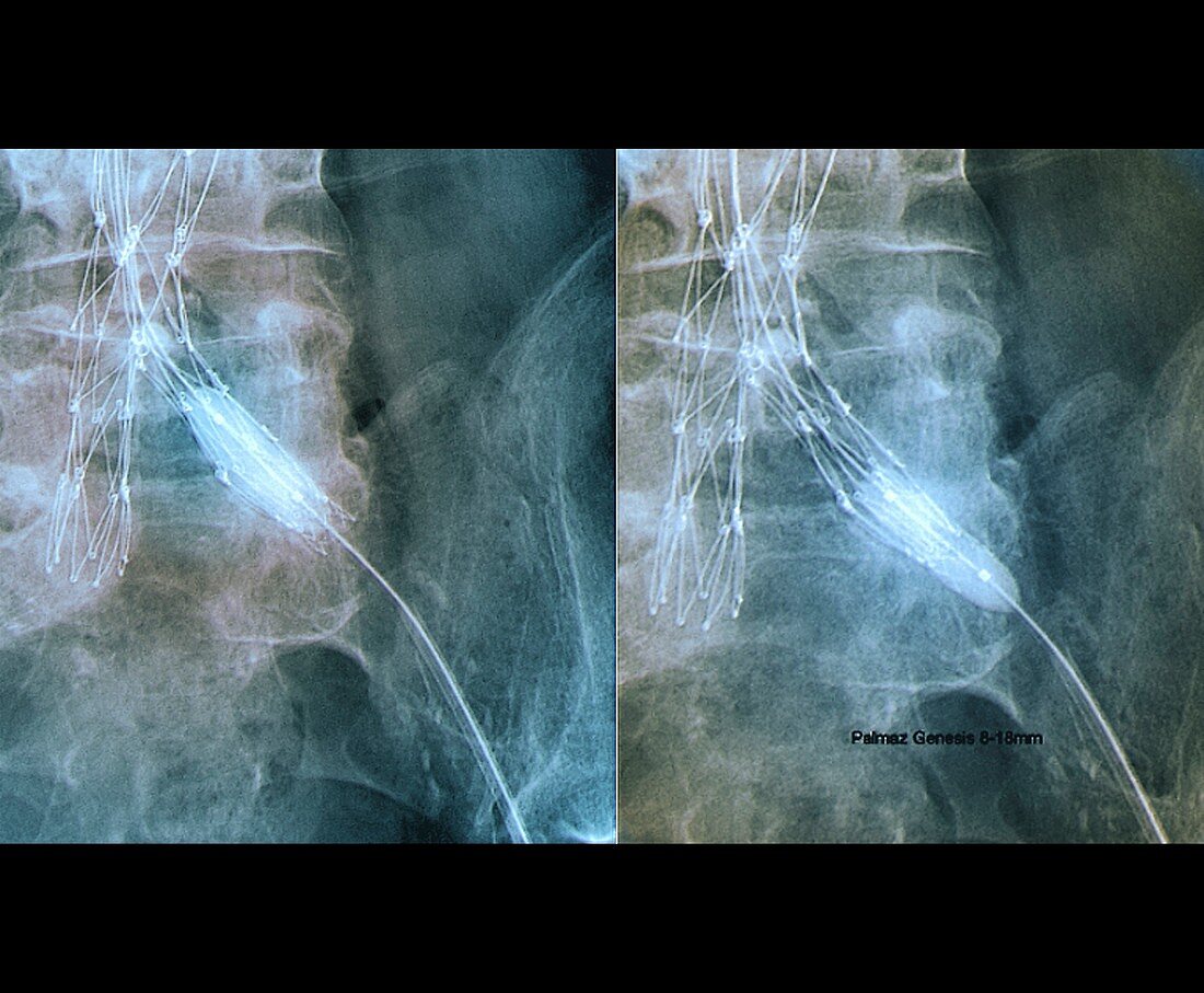 Balloon angioplasty,X-ray