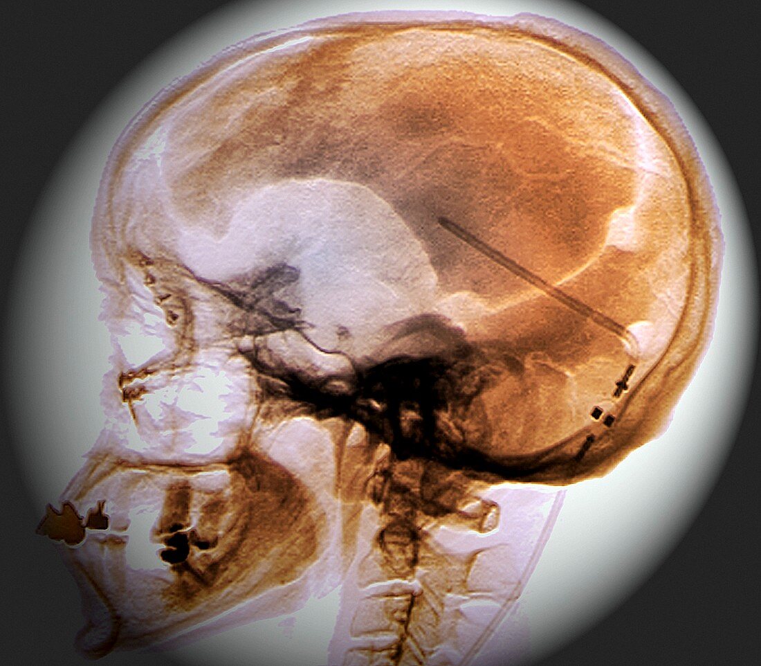 Ventricular shunt,X-ray