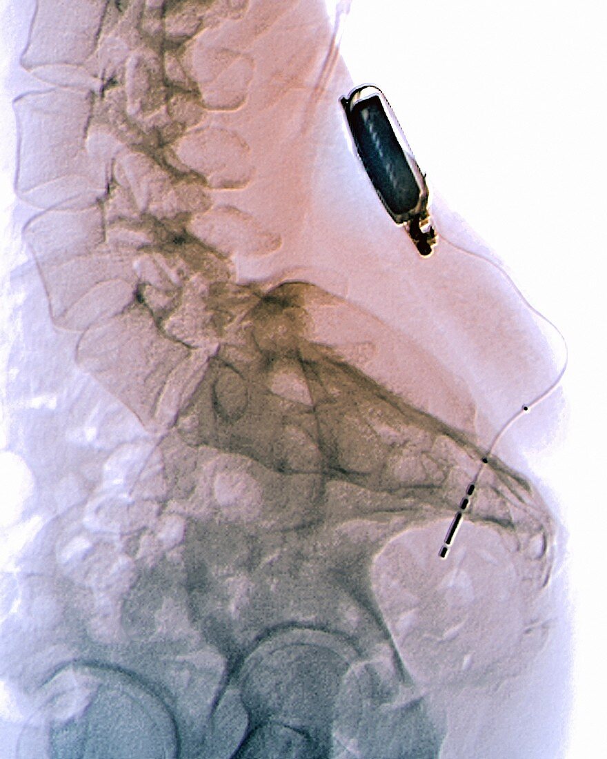 Incontinence implant,X-ray