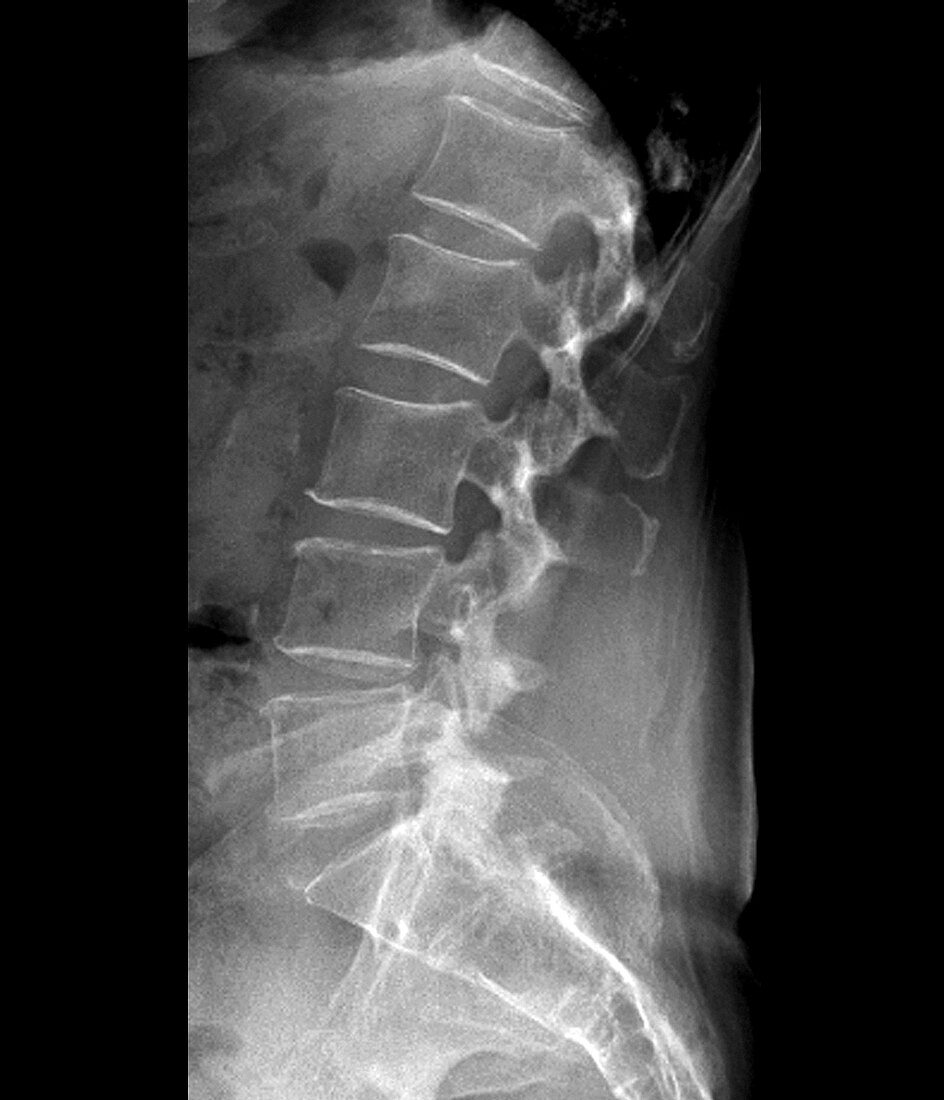 Spinal stenosis after surgery,X-ray