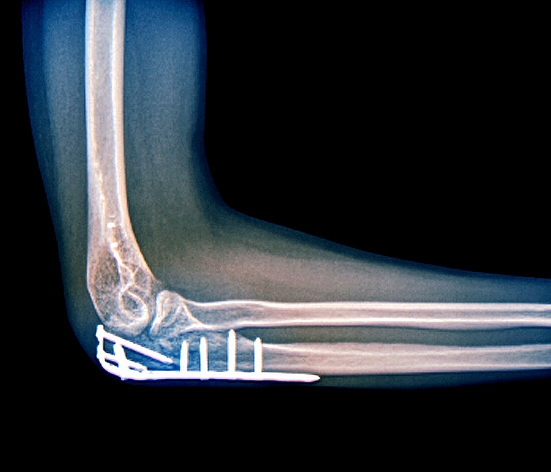 Fixed broken elbow,X-ray