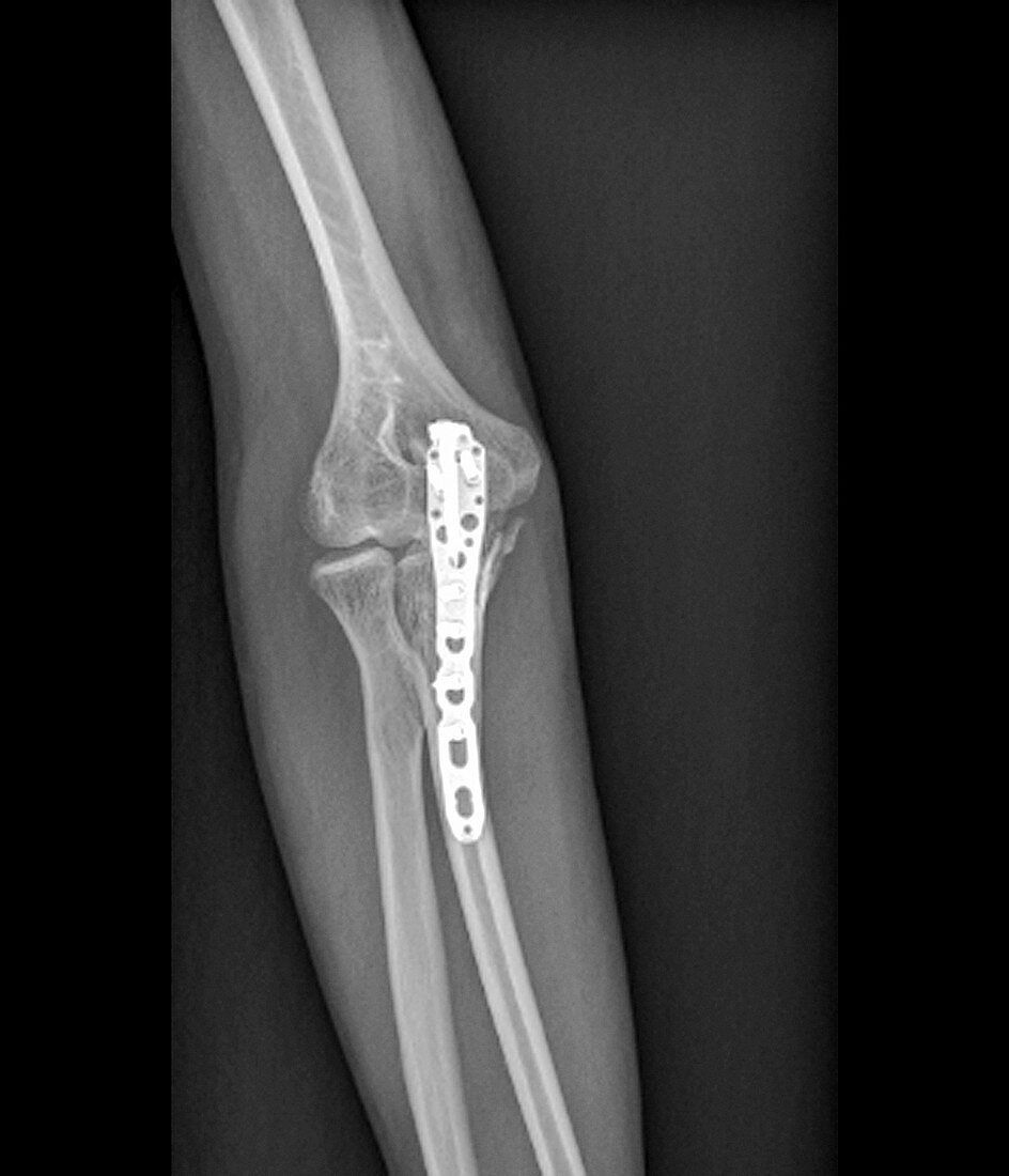 Fixed broken elbow,X-ray