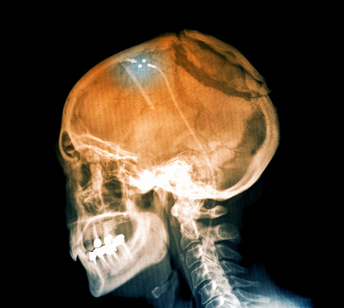 Ventricular shunt in brain tumour,X-ray