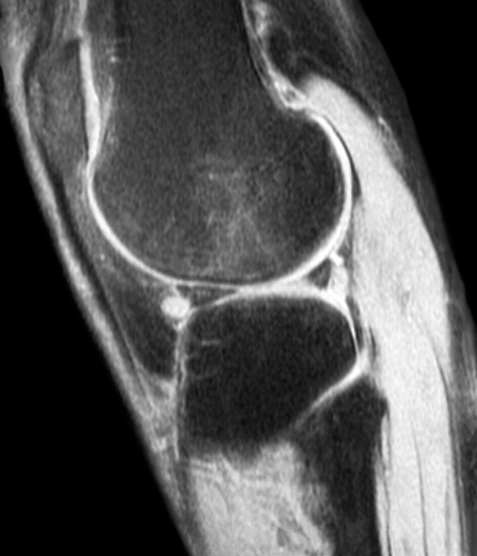 Knee cyst,MRI