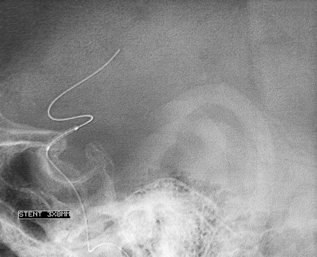 Angioplasty of the carotid artery,X-ray