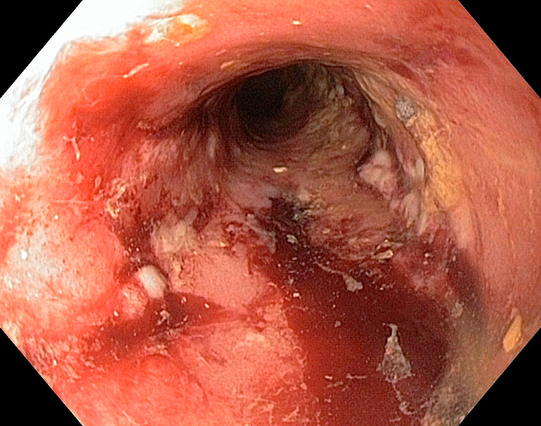 Rectal stricture in Crohn's disease
