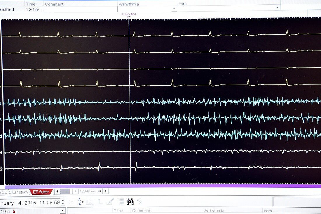 Heart surgery electrophysiology screen