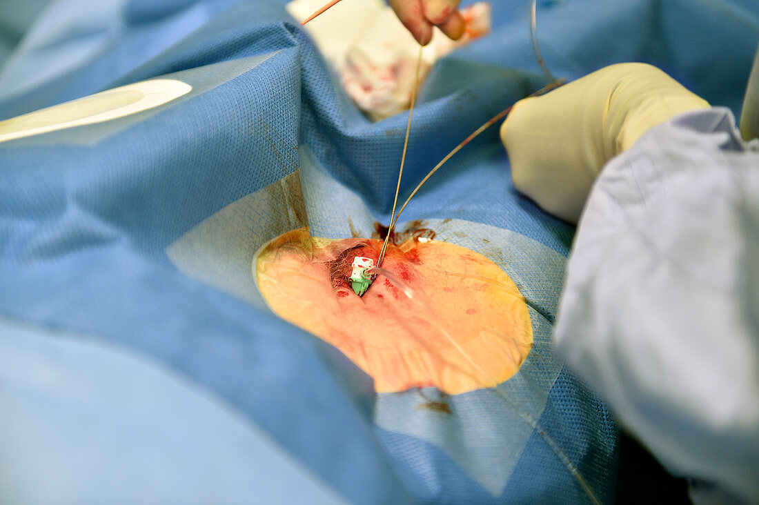 Cardiac ablation surgery catheters