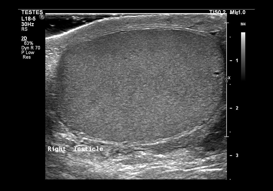Normal testicle,ultrasound scan