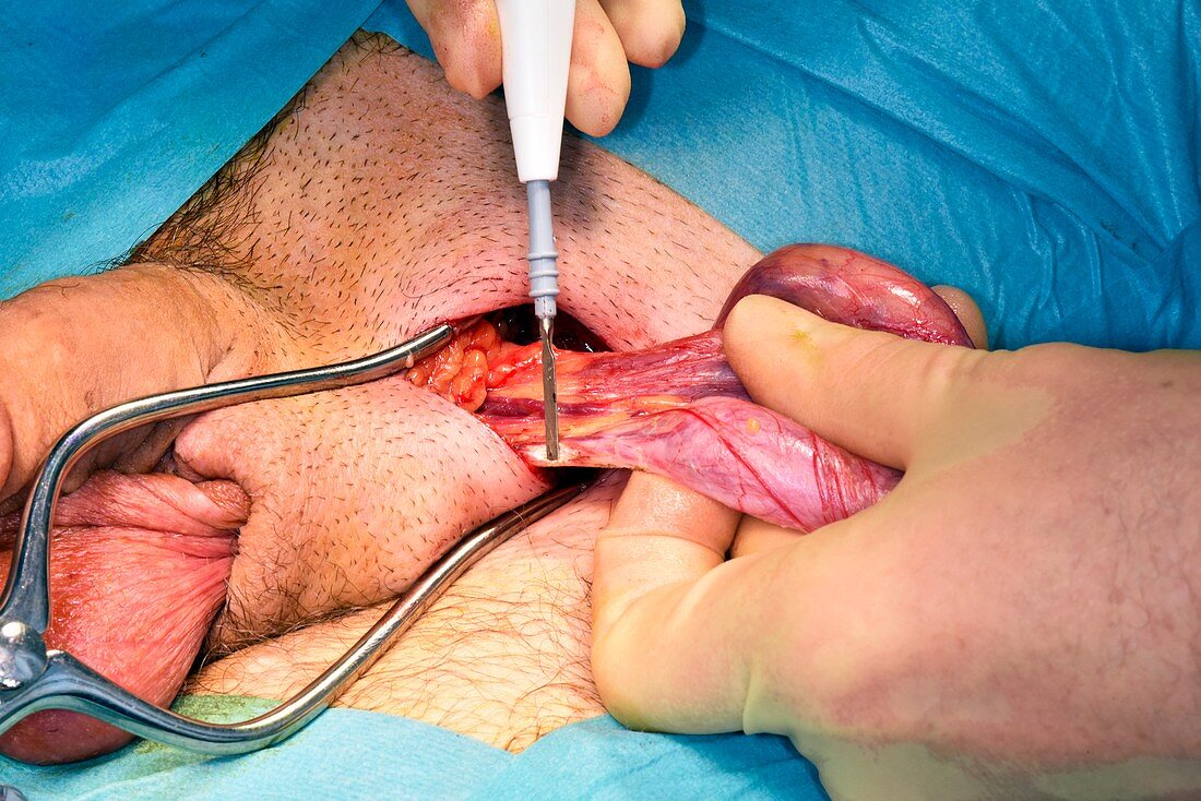 Testicular cancer surgery