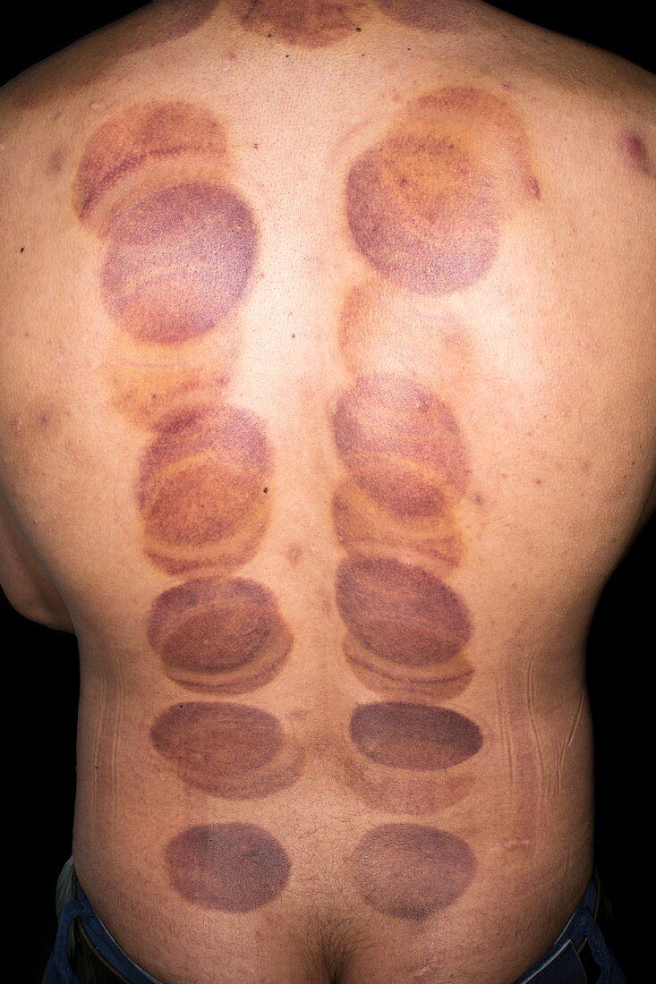 Cupping marks from cupping therapy