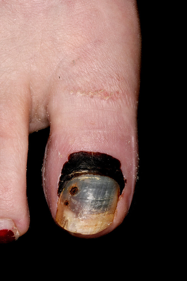 Haematoma in broken big toe