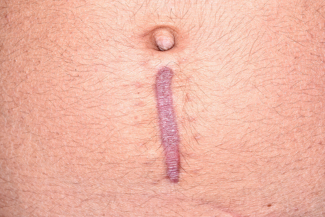Colectomy surgery scar in Crohn's disease