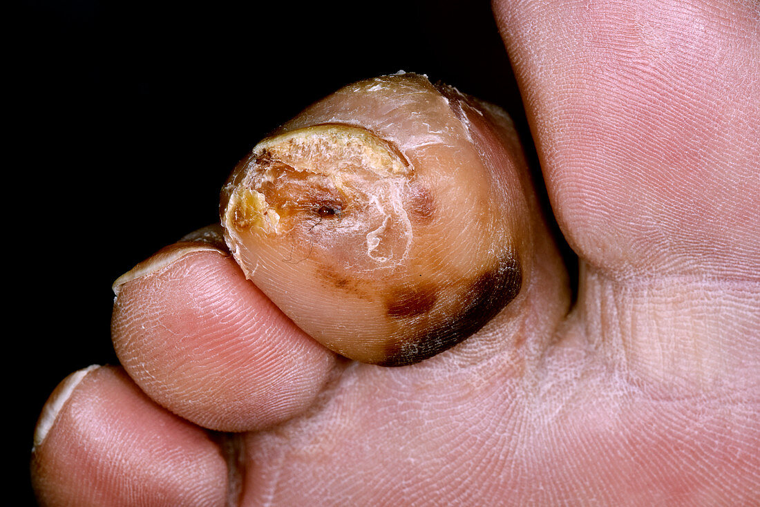 Infected toe injury in diabetic