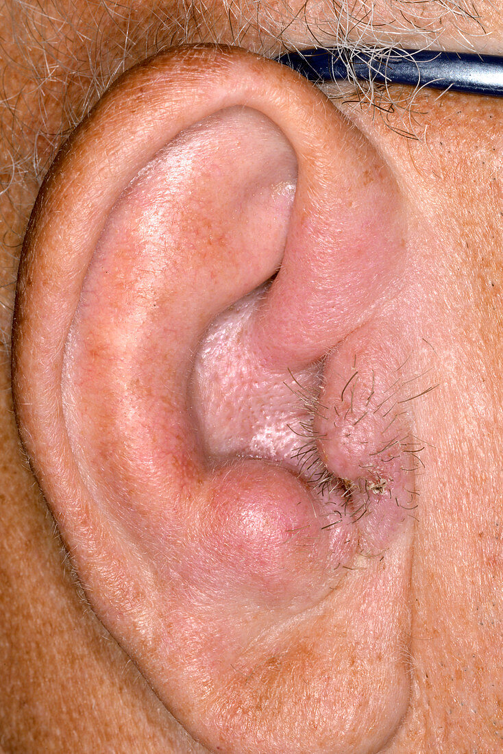 Inflamed ear