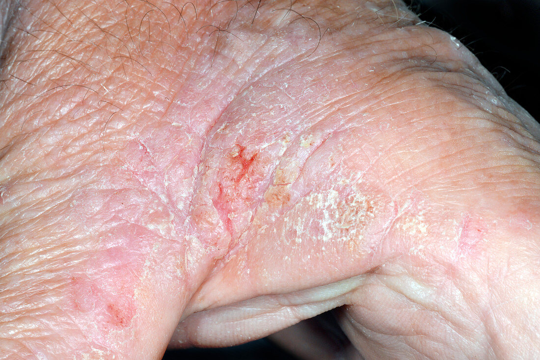 Lichen planus