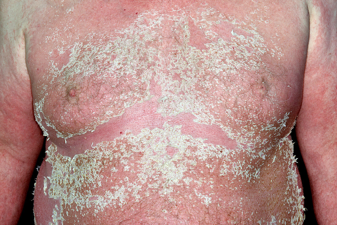 Skin peeling in allergic reaction
