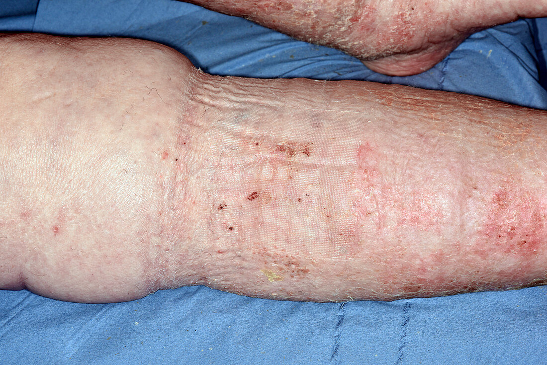 Lymphoedema following bandaging