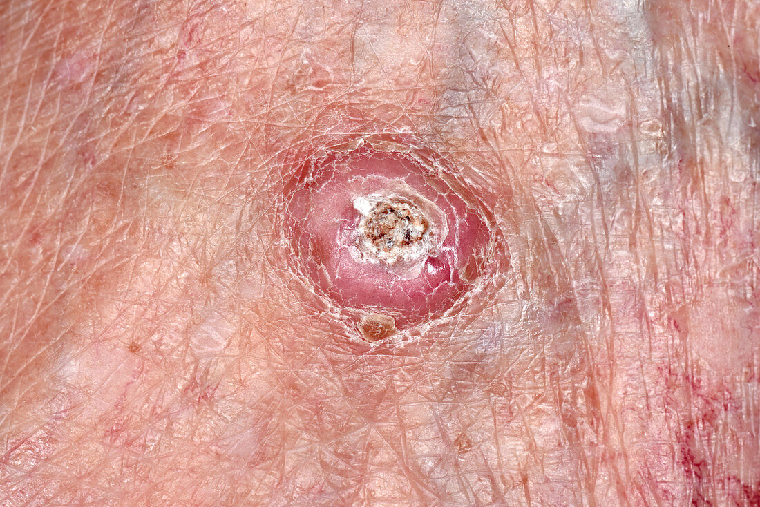 Keratoacanthoma skin cancer