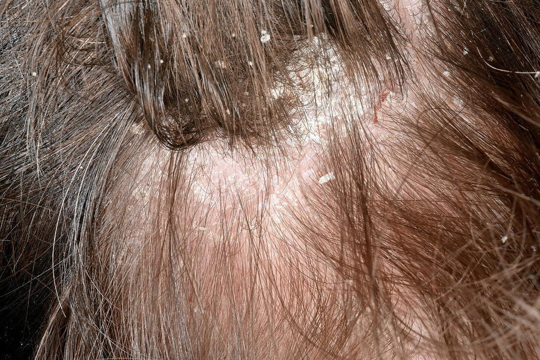 Dandruff in seborrheic dermatitis