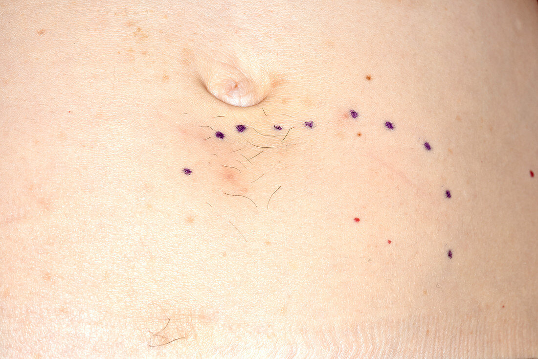 Treatment markings for uterine fibroids