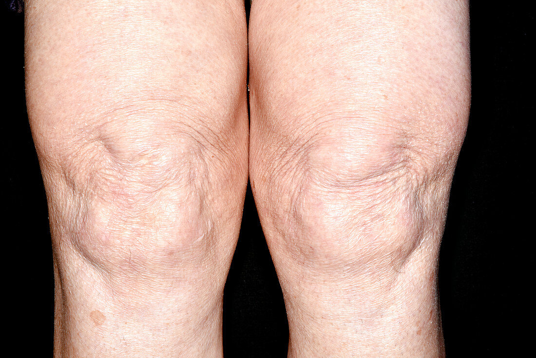 Swollen knees in polyarthritis
